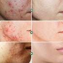 Pleťový krém proti akné